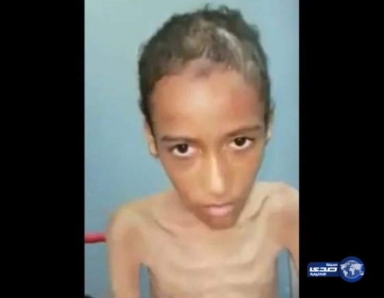 عم الطفل المعنف بخيبر يتسلمة من مركز التأهيل
