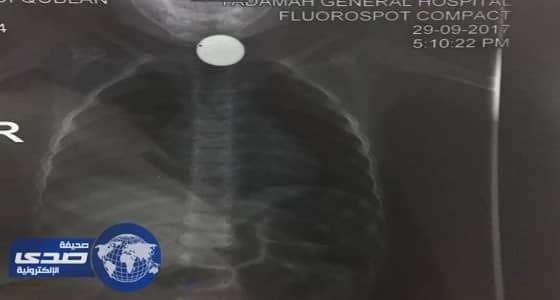 فريق طبي ينقذ حياة طفل ابتلع قطعة معدنية في نجران