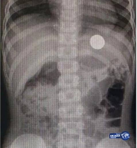 بالصور.. فريق طبي ينجح في استخراج عملة معدنية من صدر طفل ببريدة