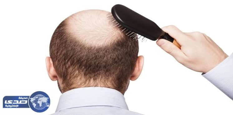 تعرف على علاج جديد لإنهاء عصر الصلع