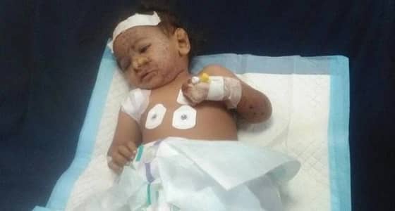 حاول التحرك تلقائيا بعد الصدمة.. طفل يمني يجد ساقه مبتورة