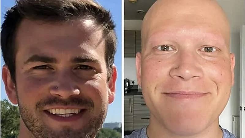 شاب يفقد 100% من شعر رأسه وجسده بشكل مرّوع