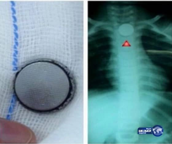 استخراج بطارية صلبة من مريء طفلة