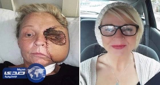 ⁠⁠⁠⁠⁠بريطانية تخسر نصف وجهها بعدما ضربت رأسها في الفرن
