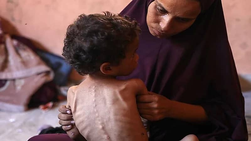 فيروس قاتل يشبه كورونا يهدد حياة الأطفال الجوعى في غزة