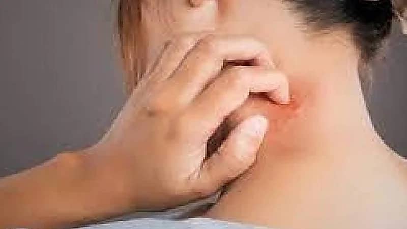 تحذير من مرض غريب ونادر ينتشر بين النساء