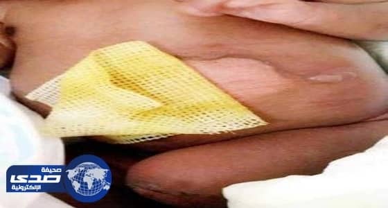 باحث يعلق على تعرض رضيع لحروق في مستشفى بيشة بسبب خطأ ممرضة