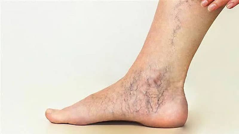 مشروب يزيد من مخاطر الإصابة بالدوالي وانسداد الأوعية الدموية