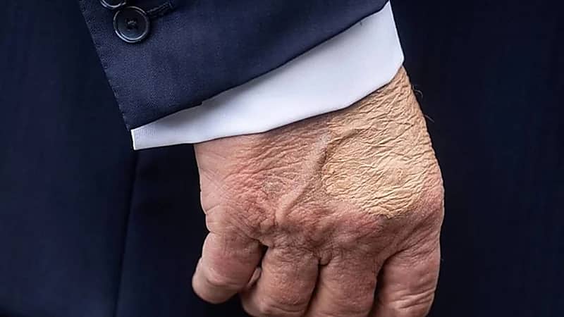 كدمة غامضة على يد ترامب تثير التساؤلات والبيت الأبيض يوضح الأسباب .. فيديو وصور