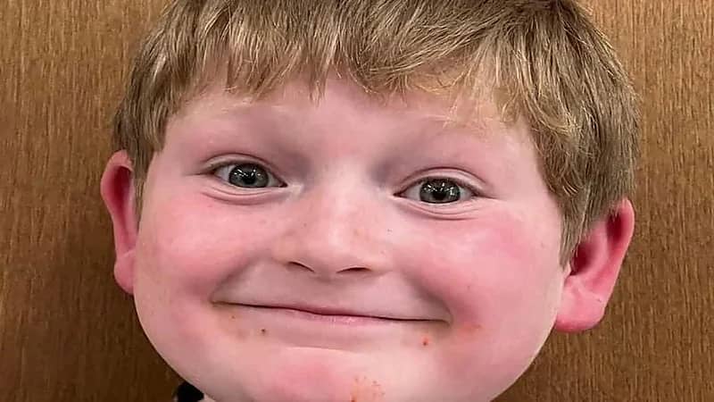 3 كلاب ضالة هاجموا طفلاً ومزقوا فروة رأسه أثناء ركوبه الدراجة