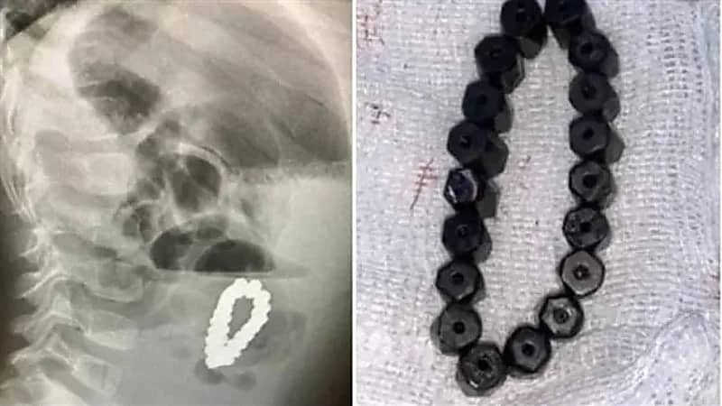 أطباء يعثرون على سوار مغناطيسي في أمعاء طفل
