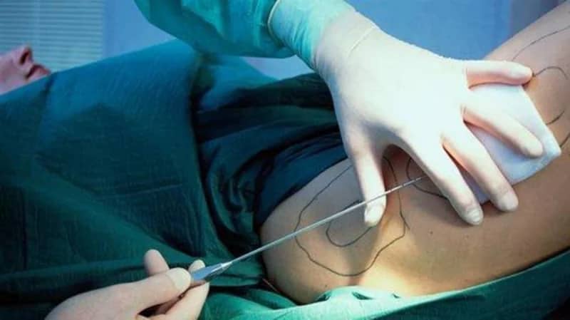 طبيب باطنة: عملية قص المعدة ليست موضة