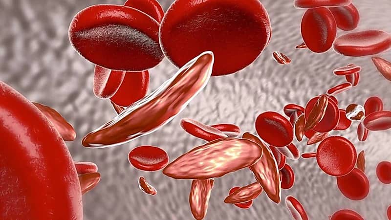 أعراض مرض الثلاسيميا والعلاجات المستخدمة لمواجهته