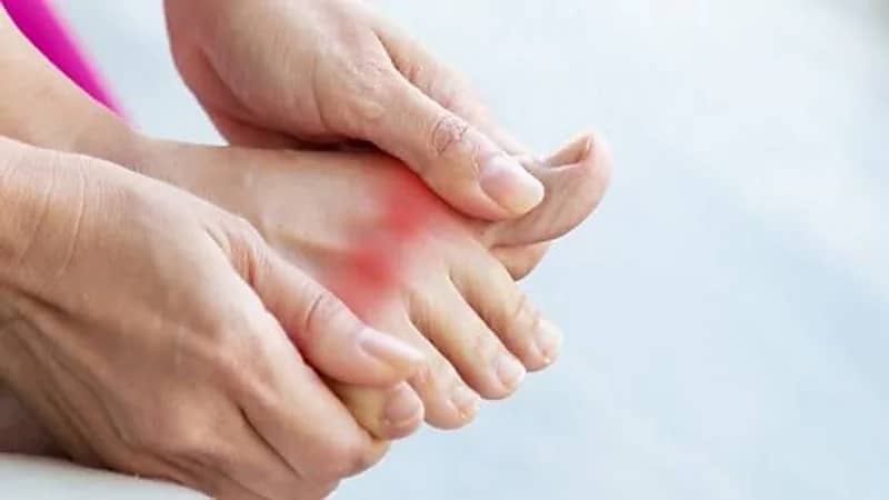 مشروب يخفف من أعراض النقرس