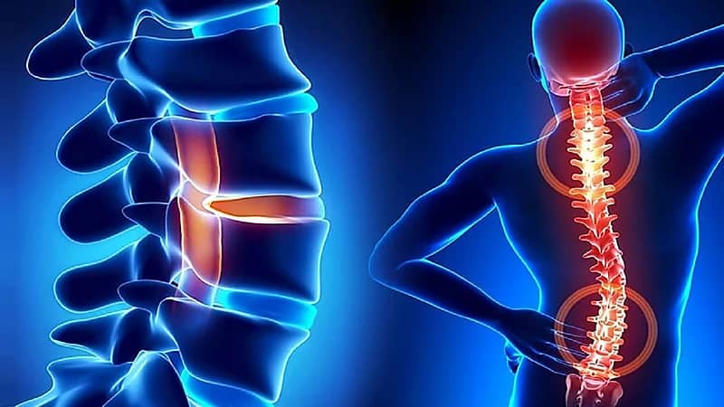 الصحة توضح طرق علاج مرض الجنف