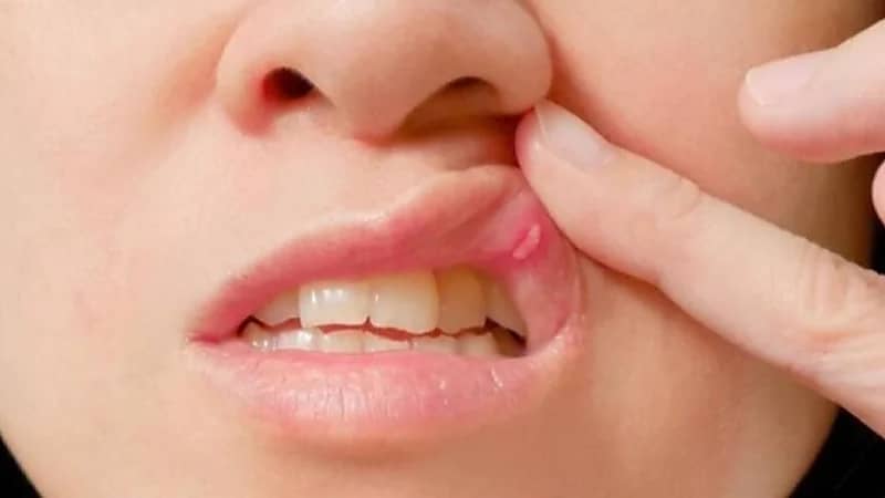 أسباب الإلتهابات والقرحات الدموية بالفم واللسان