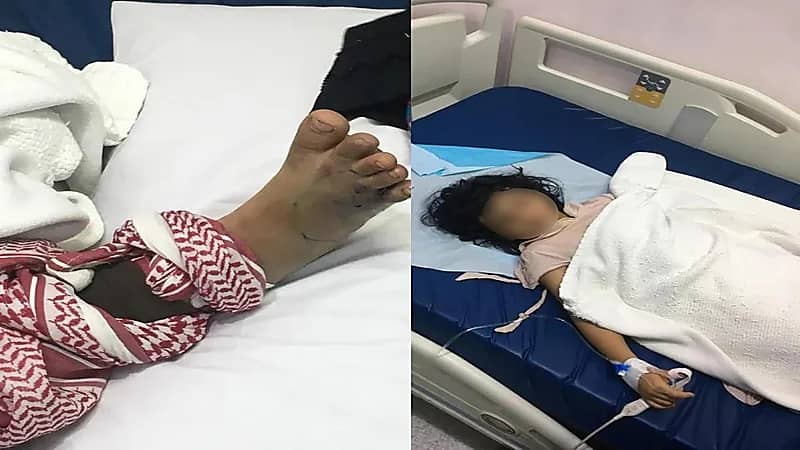 انتكاس حالة الطفلة التي لدغتها أفعى سامة في نجران