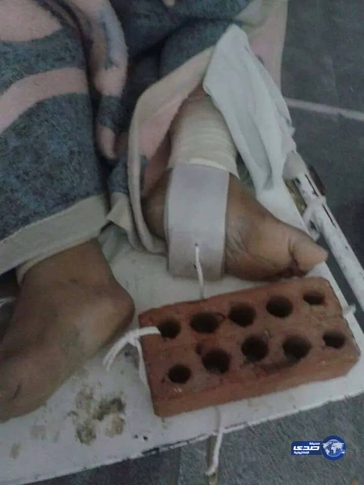 بالصور:كارثة طبية بالقاهرة ..استخدام " قالب طوب " مثبت لجبيرة جبس لمريض