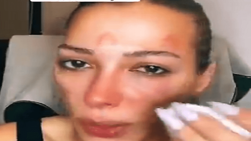 امرأة تنهار بالبكاء بسبب تشوه وجهها بعد حقنة فيلر..فيديو