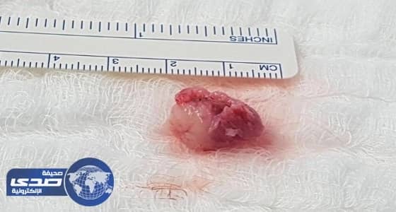 استئصال ورم من نخاع ستينية في جراحة استمرت 5 ساعات