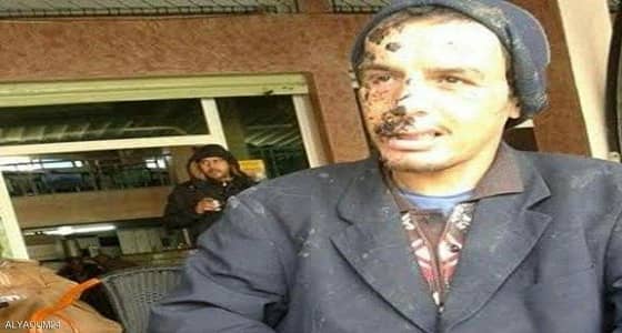 مرض نادر يرتفع بشاب مغربي فى السماء ويسقطه على وجهه أرضاً