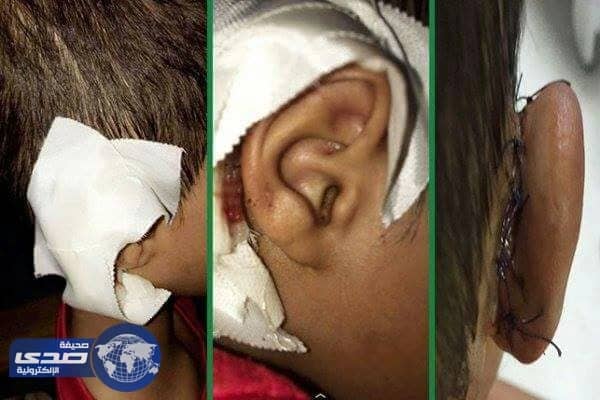 تعليم جازان يتفاعل مع شكوى مواطن اتهم معلما بخلع أذن ابنه