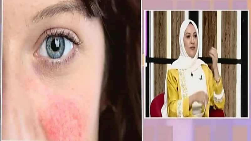 استشارية : مرض الذئبة الحمراء له علاج ولكن ليس جذري.. وهذه طريق السيطرة عليه (فيديو)