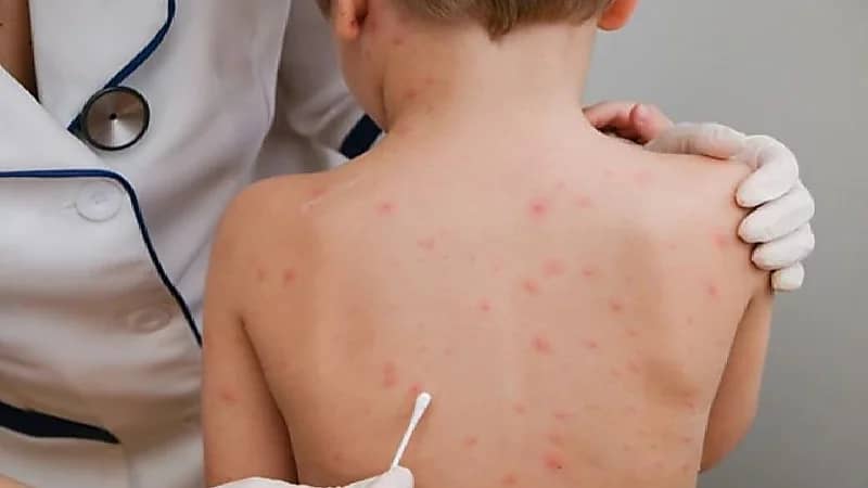 بالفيديو .. مستشار: جدري القردة مرض معروف وفرصة انتشاره ضئيلة