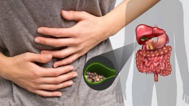 استشاري يكشف عن 5 عوامل تسبب حصوات المرارة