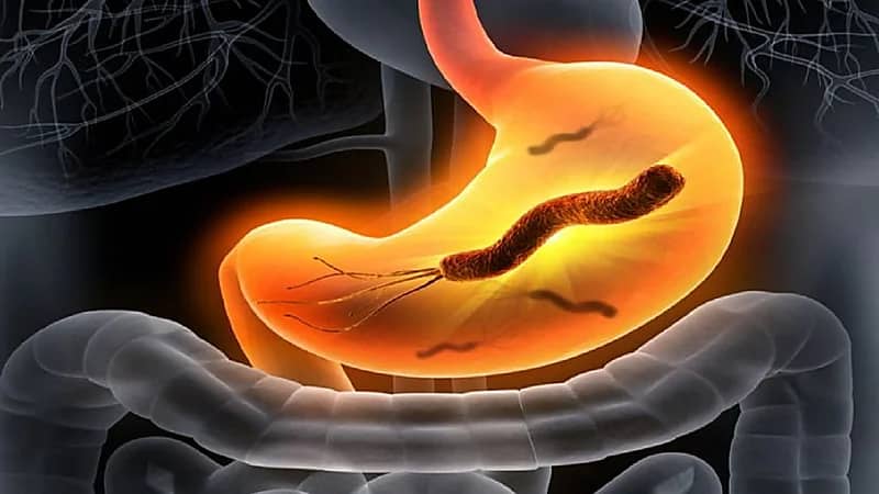 استشاري: نسبة انتشار جرثومة المعدة في بعض المناطق تصل لـ50%