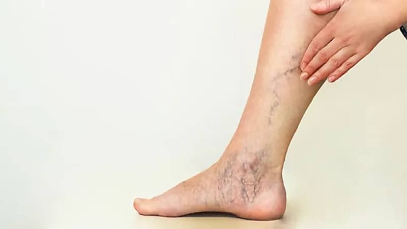 أسباب دوالي الساقين وطرق الوقاية