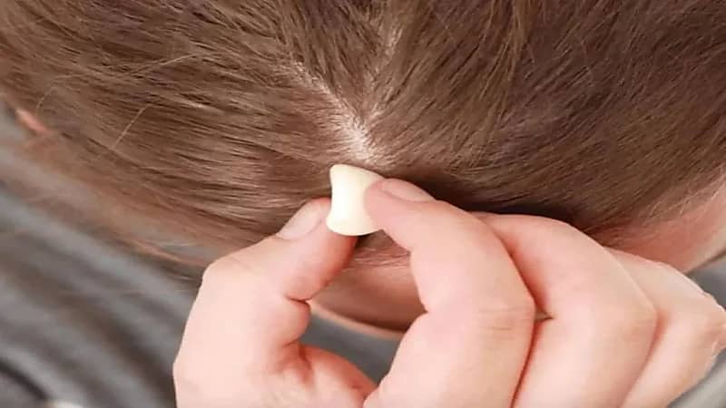 استشاري جلدية: الثوم يقتل بصيلات الشعر.. فيديو