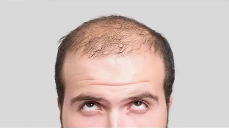 اكتشاف علاج طبيعي لتساقط الشعر دون الحاجة إلى الزراعة