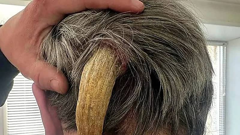 رجل يتخلص بنجاح من قرن عانى منه لمدة ثلاث سنوات