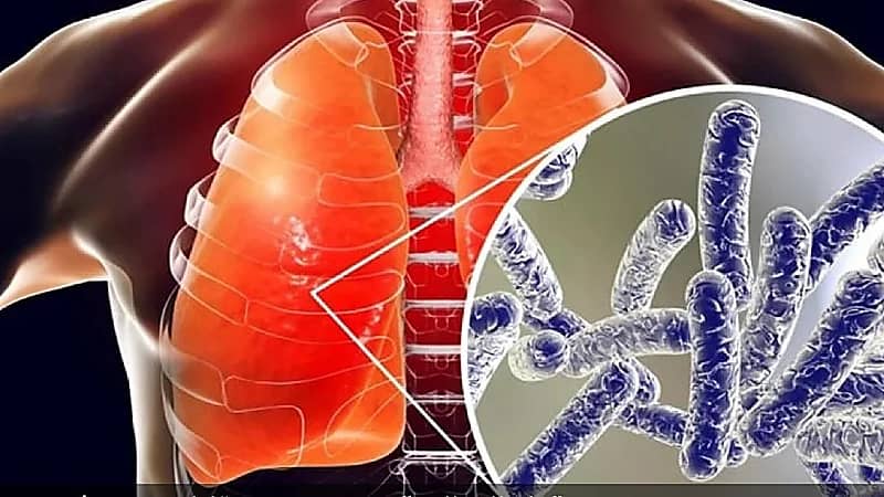 مخاوف وتحذيرات من انتشار داء الفيالقة