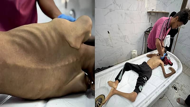 الجوع ينهي حياة الأطفال وانهيار طاقم طبي في مجمع الشفاء بغزة.. فيديو وصور