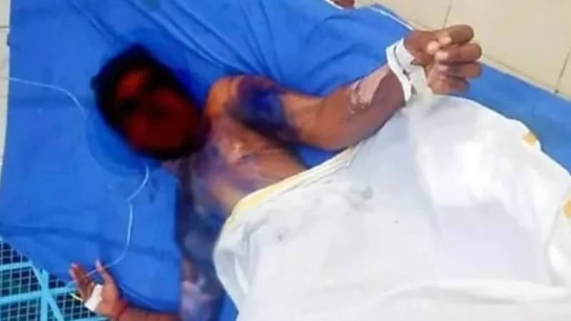 امرأة تحرق زوجها بسبب خيانته