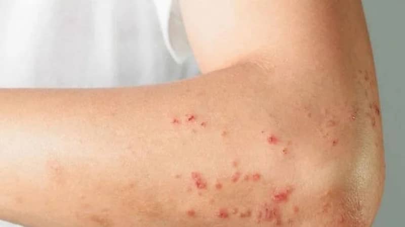 كندا تسجل 10 إصابات جديدة بجدري القرود