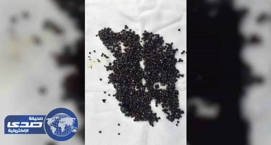 أطباء إماراتيون ينجحون في استخراج 1600 حصوة من مرارة امرأة