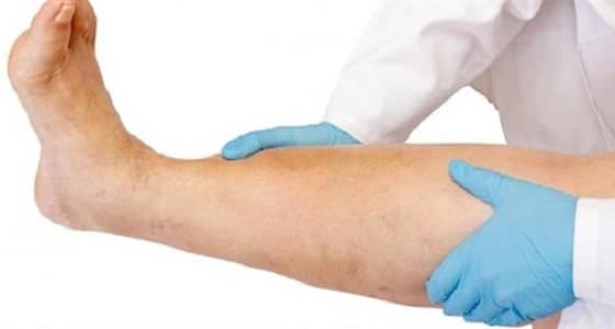 " النمر " يوضح مضاعفات جلطة الساق