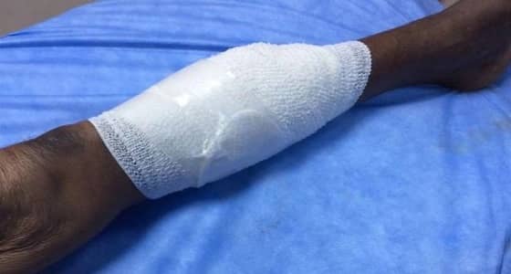 بالصور.. كلب شرس يهاجم ثمانيني في قرية الخمس بجازان