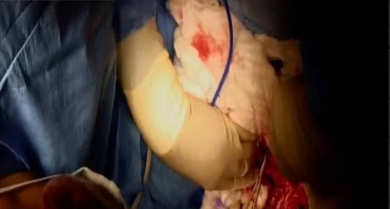 الصور الأولى لعملية فصل التوأم السيامي " فرح وحنين "
