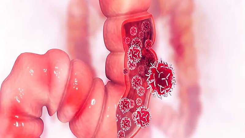 ثلاثة أطعمة منتشرة تسبب أمراض خطيرة