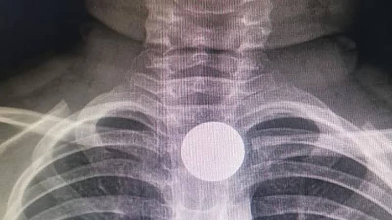 تفاصيل انقاذ حياة طفل في الخفجي ابتلع قطعة معدنية