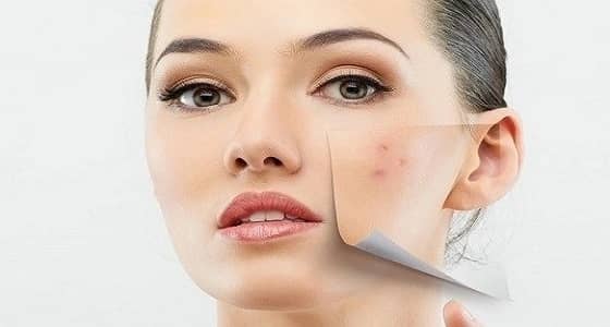 حاربي البثور الهرمونية بهذه الطرق
