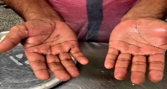 ضبط مخالفات صحية في أحد المطاعم بنجران