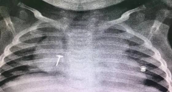 إنقاذ رضيع ابتلع جسم معدني بـ " سعود الطبية "