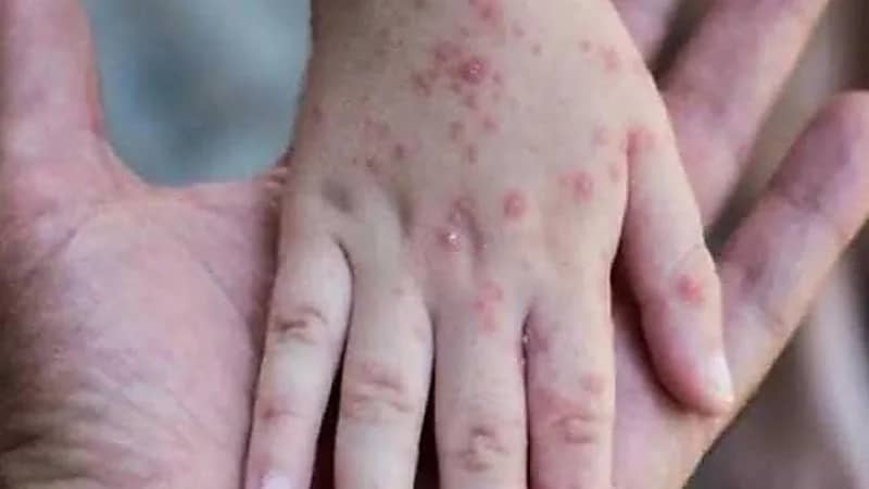 أعراض وأسباب الإصابة بجدري القرود