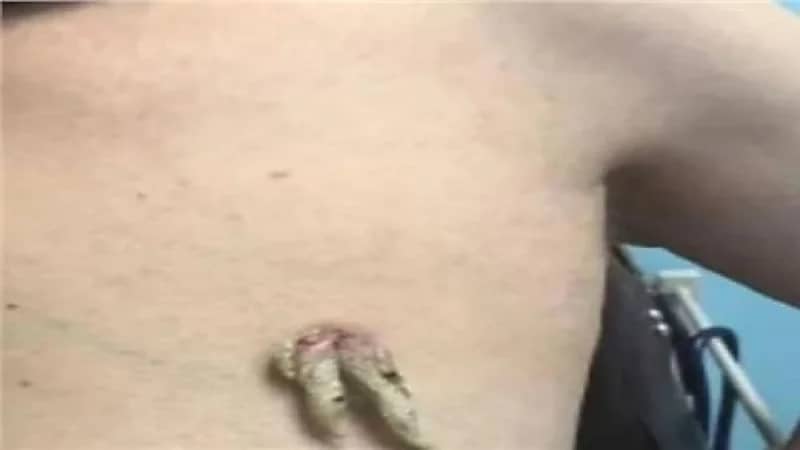 ظهور قرون مخيفة بجسد امرأة مسنة