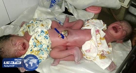 بالصور.. فشل تحديد جنس توأم ملتصق في الهند